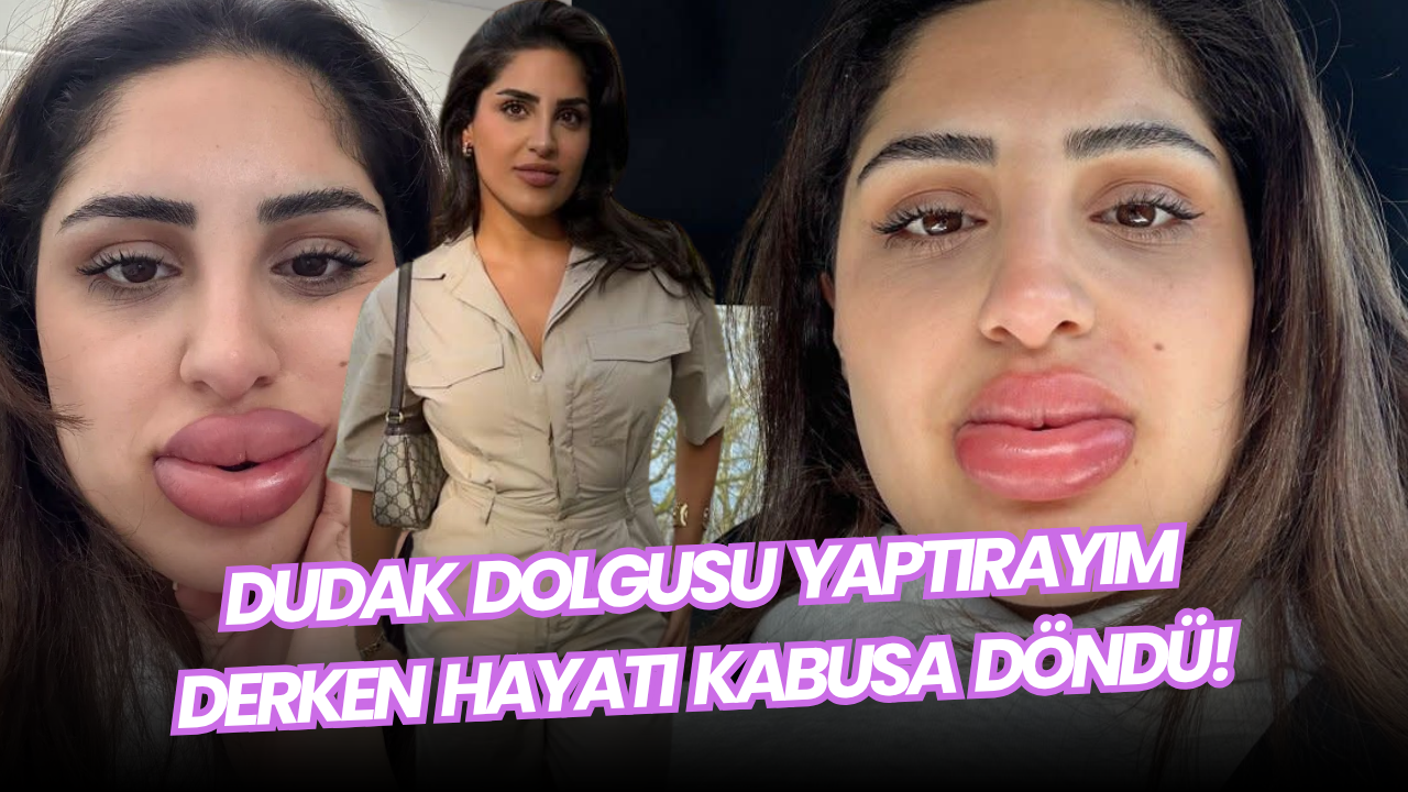 Dudak Dolgusu Yaptırayım Derken Hayatı Kabusa Döndü!