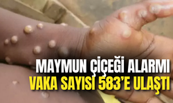 Maymun Çiçeği Alarmı: Vaka Sayısı 583’e Ulaştı, 1 Kişi Hayatını Kaybetti