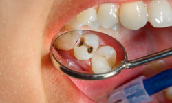 Kanal tedavisi nedir, kimlere yapılır?