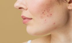 Sivilce tedavisinde kullanılan Retinoik asit için kritik uyarılar!