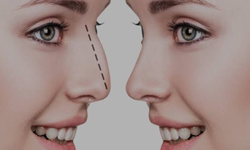 Burun estetiği sonrası iyileşme sürecinde bunlara dikkat