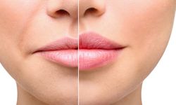 Dudak dolgusu hakkında en sık yapılan 3 büyük yanılgı