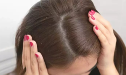 Kepek oluşumunun nedenleri ve etkili çözüm yolları