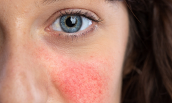 Gül hastalığı (Roza) nedir? Neden olur?