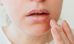 Basit görünen uçuk sandığınız kadar masum olmayabilir