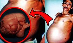 “Hamile adam” gerçeği: Karnından 36 yıllık ikizi çıktı