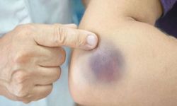 Vücudunuz neden çabuk morarıyor?