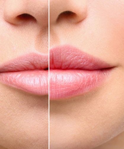 Dudak dolgusu hakkında en sık yapılan 3 büyük yanılgı