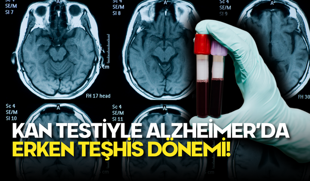 Kan Testiyle Alzheimer’da Erken Teşhis Dönemi