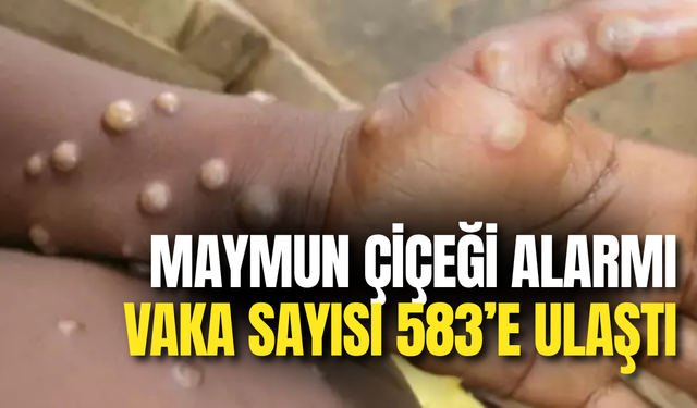 Maymun Çiçeği Alarmı: Vaka Sayısı 583’e Ulaştı, 1 Kişi Hayatını Kaybetti