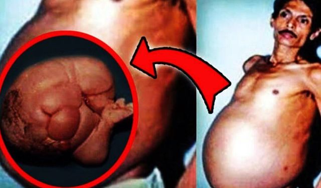 “Hamile adam” gerçeği: Karnından 36 yıllık ikizi çıktı