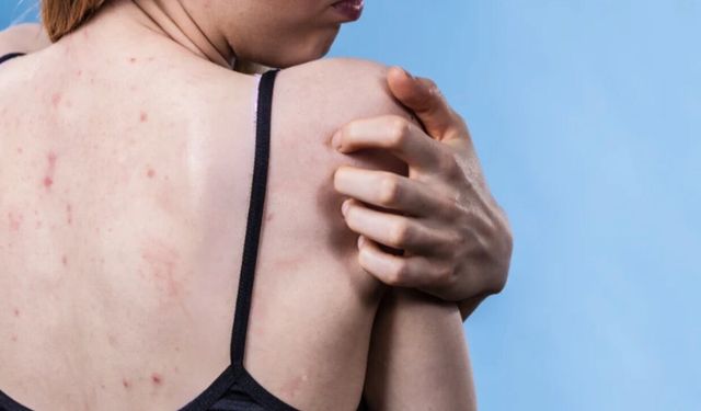 Yaz gelmeden çözün: Vücut sivilcelerini azaltmanın 3 yolu