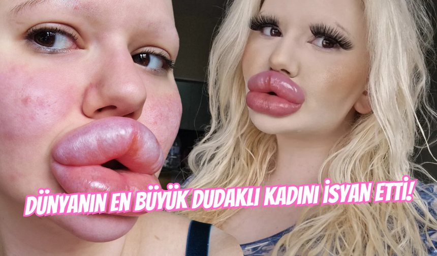 Dünyanın En Büyük Dudaklı Kadını Acı Gerçekle Karşılaştı! Estetik Uğruna 20 Bin Sterlin Harcamış...