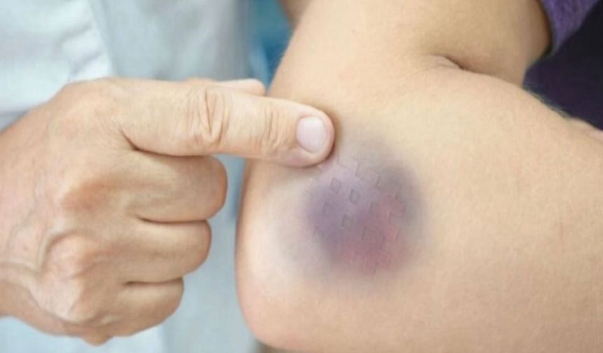 Vücudunuz neden çabuk morarıyor? Basit bir çarpma mı yoksa gizli bir hastalık mı?