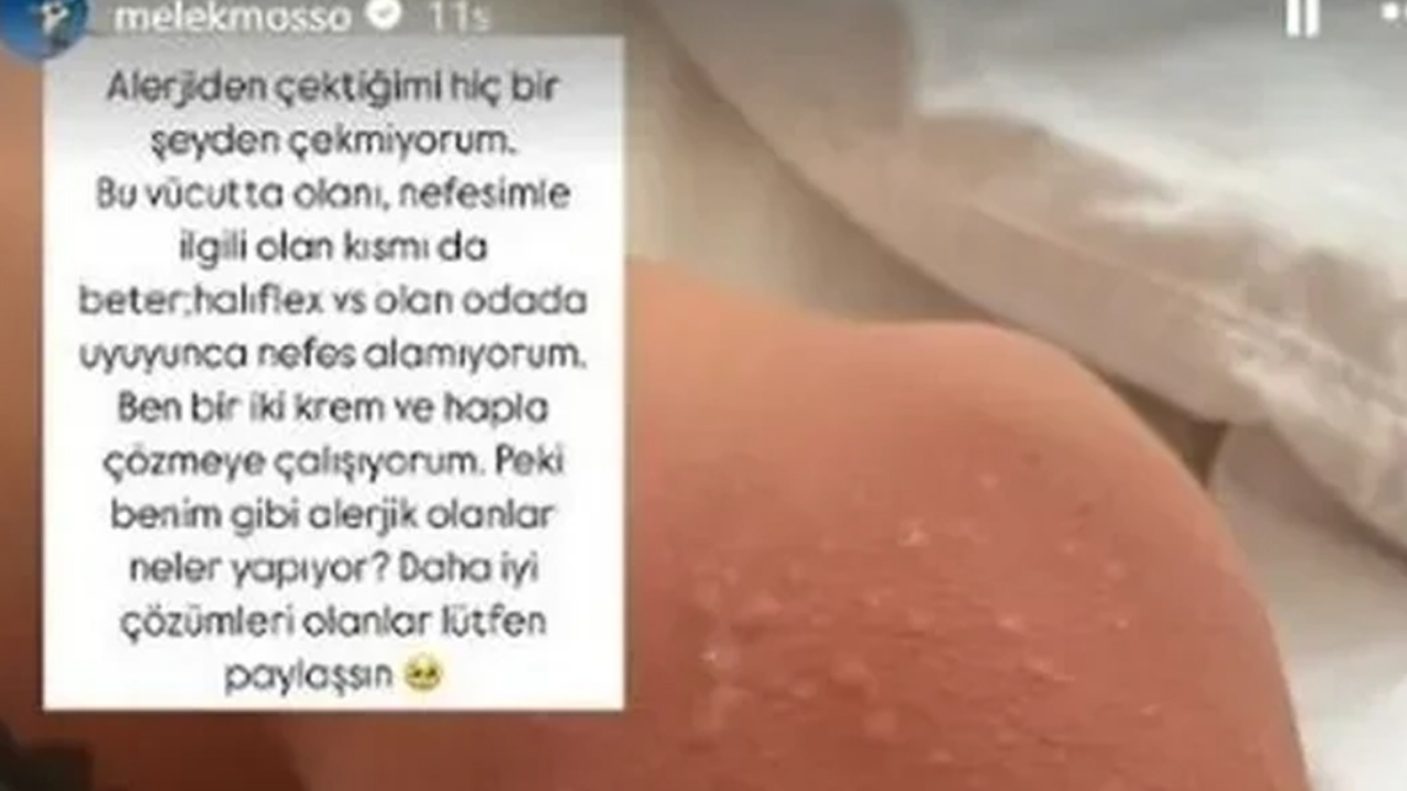 Melek Mosso’nun Bali Tatili Kabusa Döndü Hem Alerji Hem ‘Bali Belly’ (1)