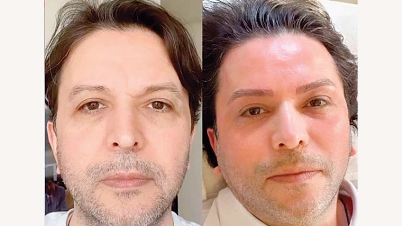 Nihat Doğan’ın Estetik Dönüşümü Şaşkına Çevirdi Son Hali Sosyal Medyayı Salladı