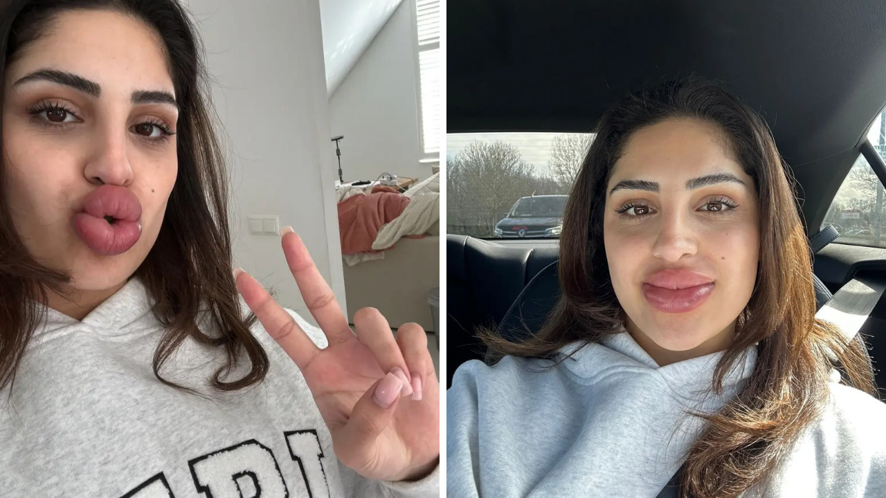 Dudak Dolgusu Yaptırayım Derken Hayatı Kabusa Döndü! (2)