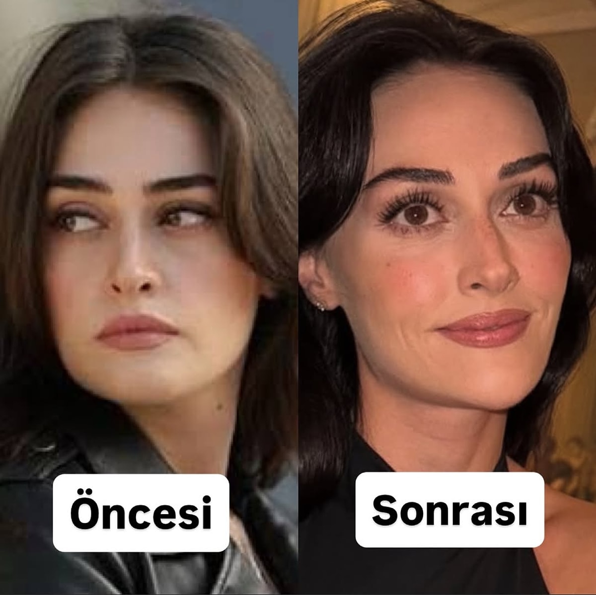 Esra Bilgiç’in Son Hali Takipçilerini İkiye Böldü! Estetik Sırrı Ortaya Çıktı…