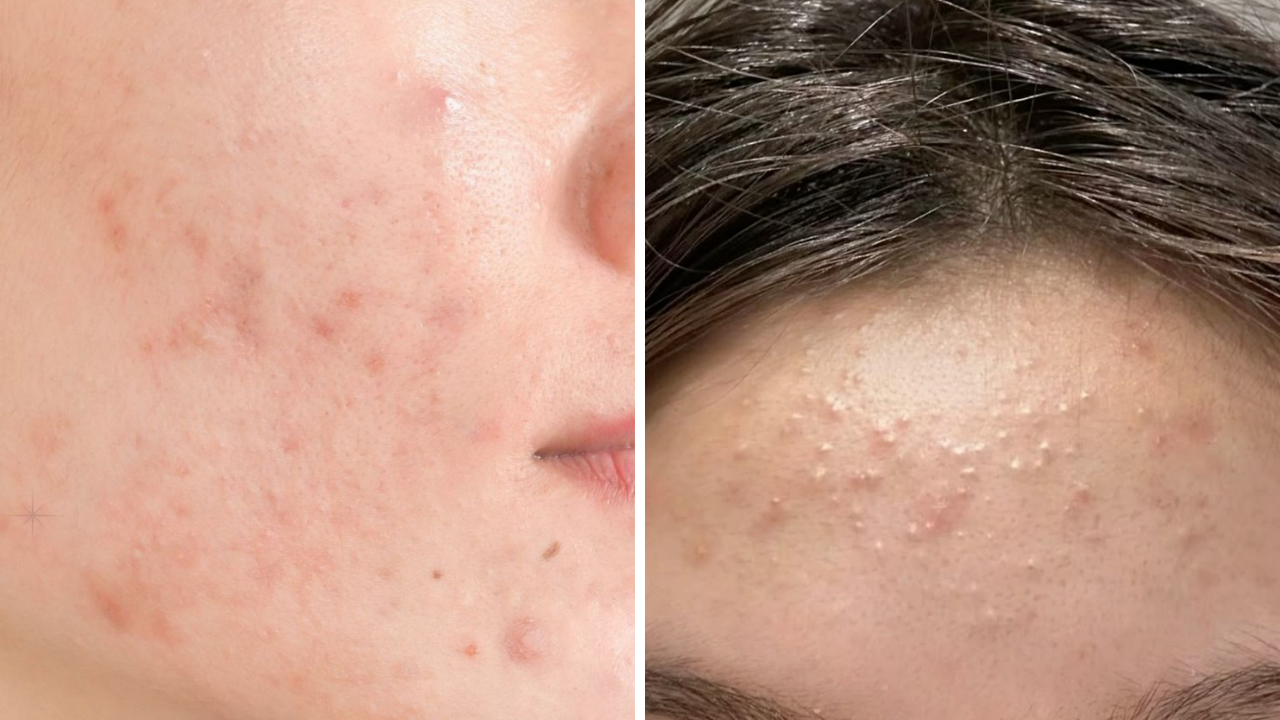 Hasarlı Cilt Bariyeri Nasıl Düzeltilir