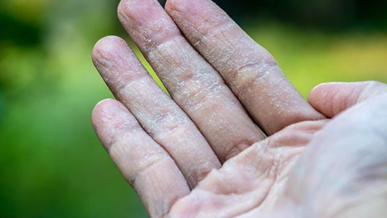 Kışın El Çatlamasına Ne Iyi Gelir (1)