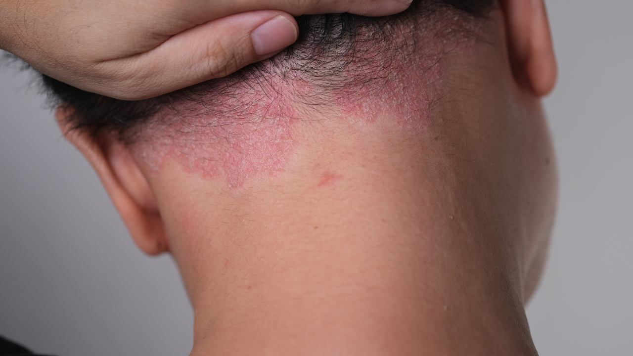 Soğuk Havalarda Artan 5 Cilt Hastalığına Dikkat! (2)