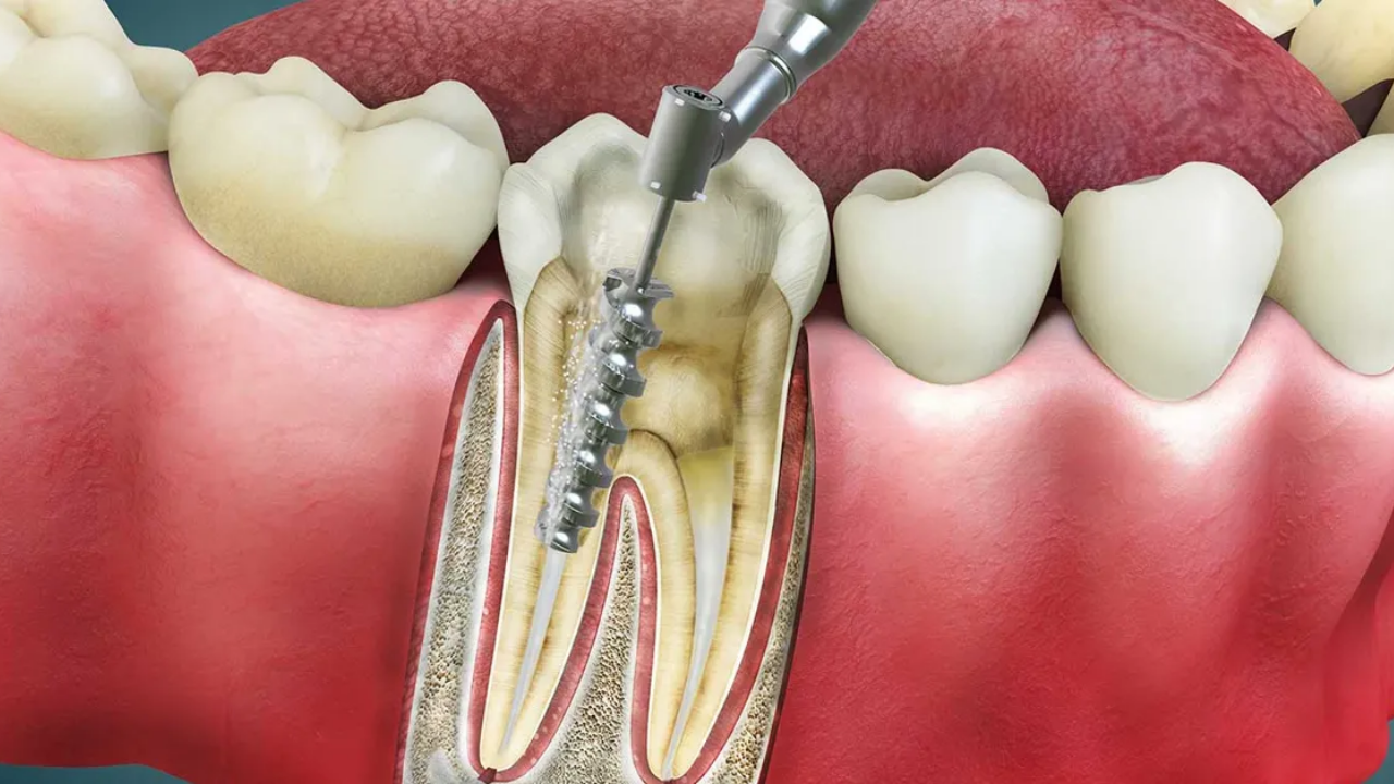 Kanal Tedavisi Nedir, Kimlere Yapılır (1)
