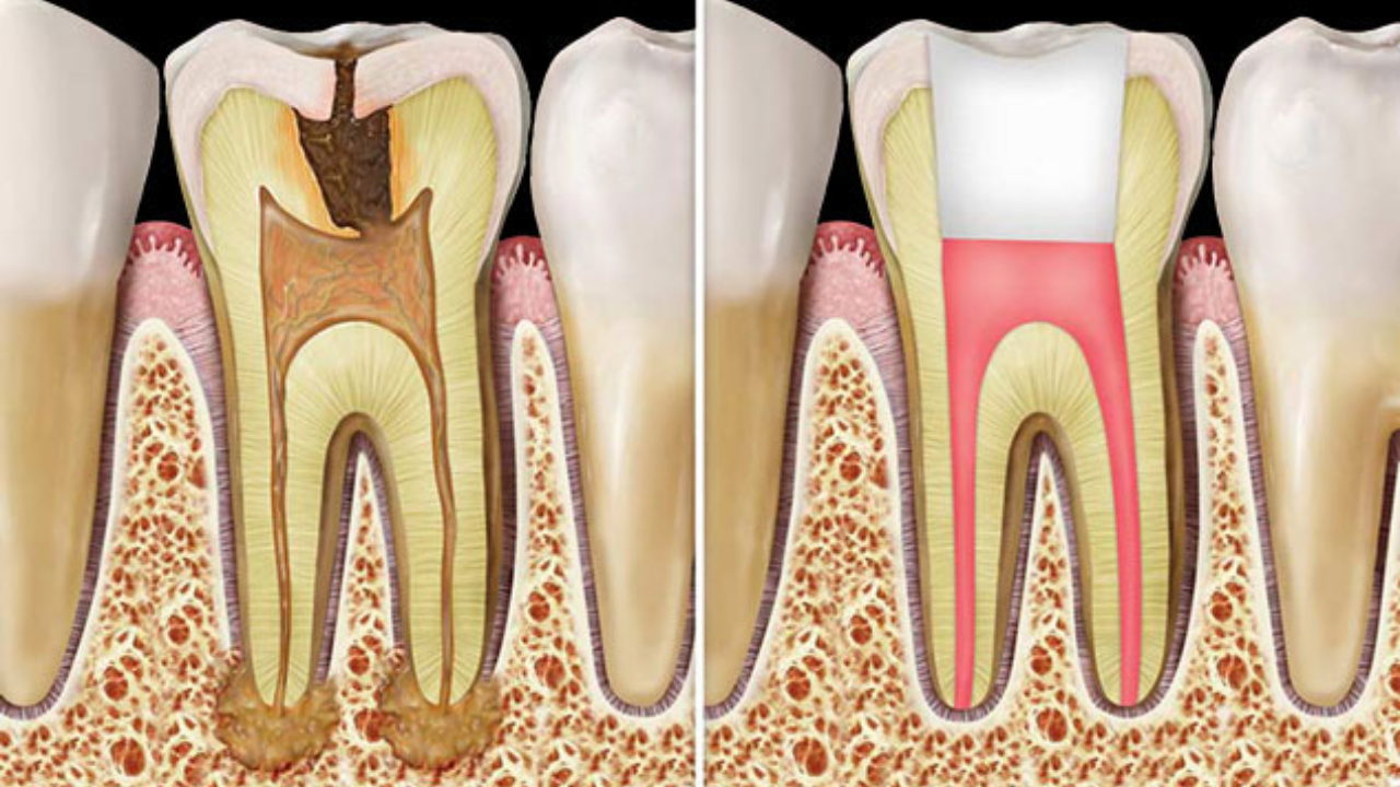 Kanal Tedavisi Nedir, Kimlere Yapılır