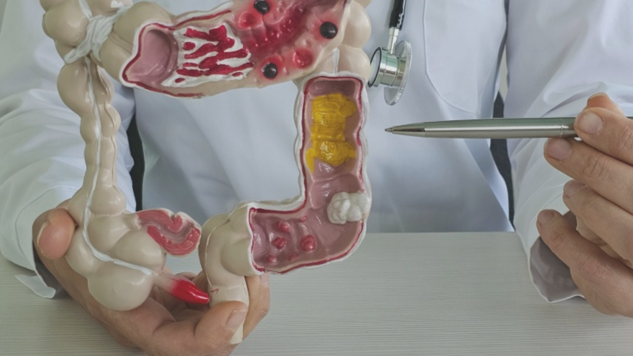 Murat Cemcir'in Hastalığı Divertikül Kanaması Nedir (1)