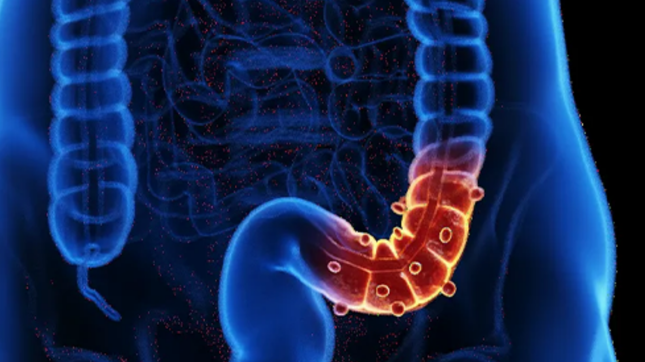 Murat Cemcir'in Hastalığı Divertikül Kanaması Nedir (3)