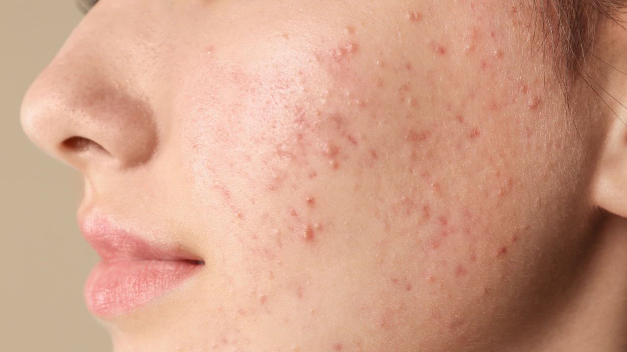 Sivilceye Neden Olan 3 Büyük Cilt Bakım Hatası (1)