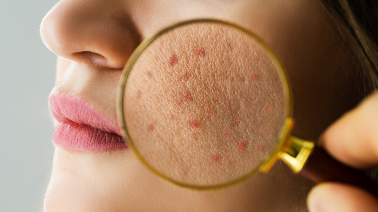 Sivilceye Neden Olan 3 Büyük Cilt Bakım Hatası