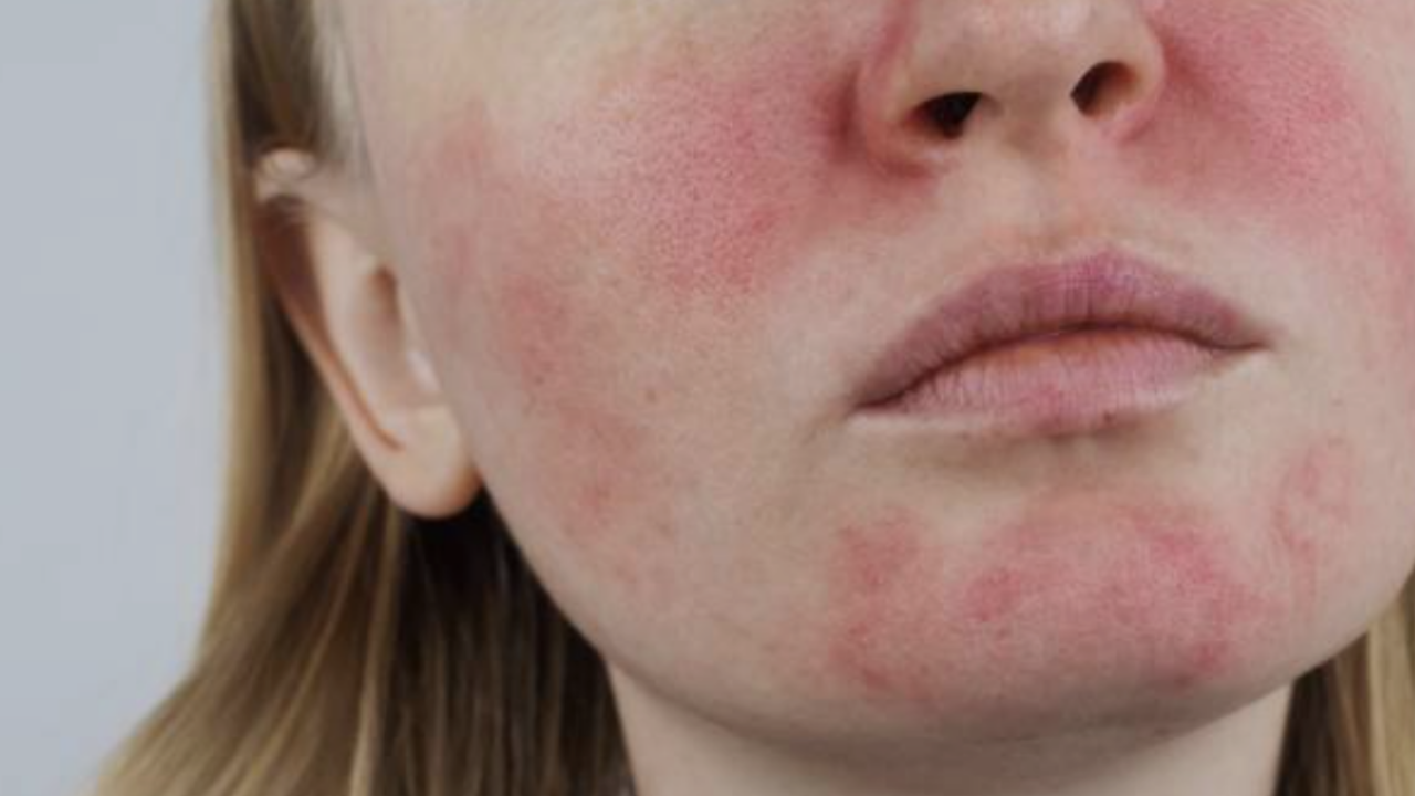 Roza Hastalığı (1)