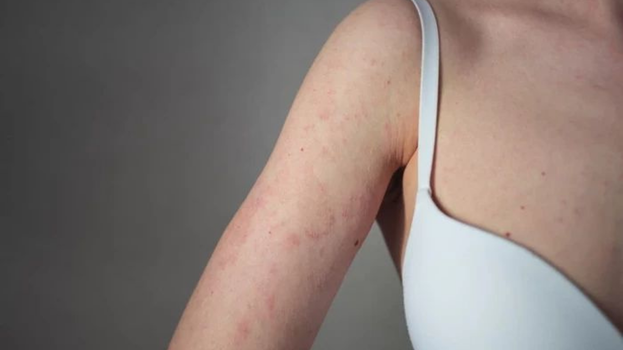 Vücut Sivilceleri (2)