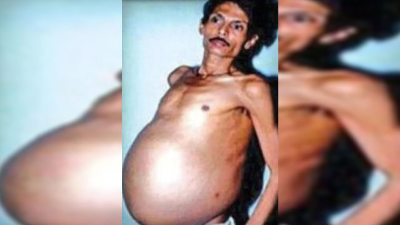 Ikizini Karnında Taşıyan Adam 3