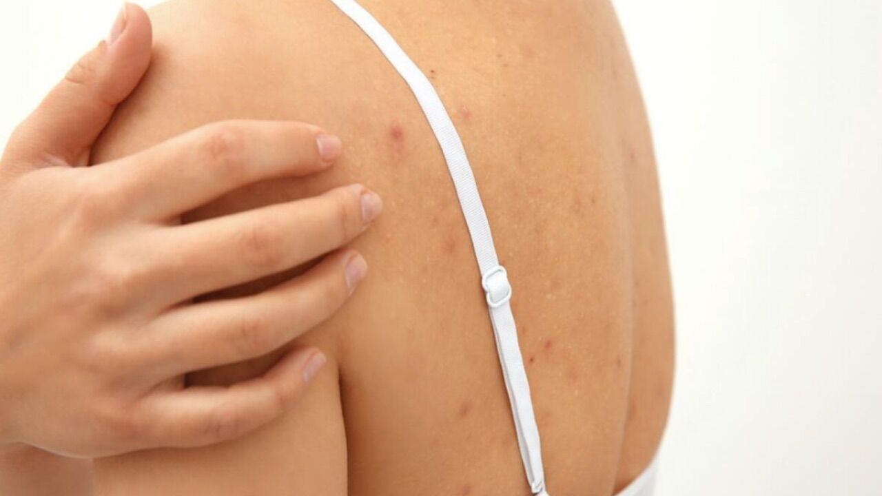 Vücut Sivilceleri 3